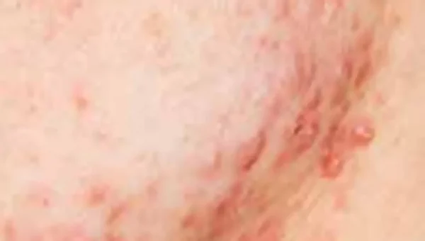 Curing ACNE With Ozone Therapy​