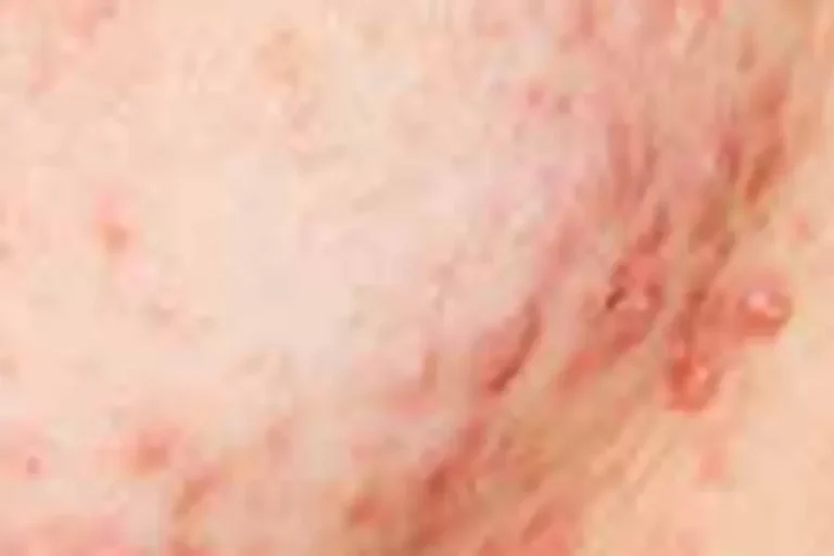 ACNE Curing ACNE With Ozone Therapy