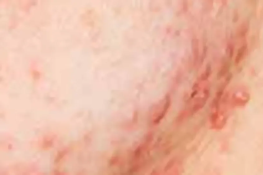 ACNE Curing ACNE With Ozone Therapy