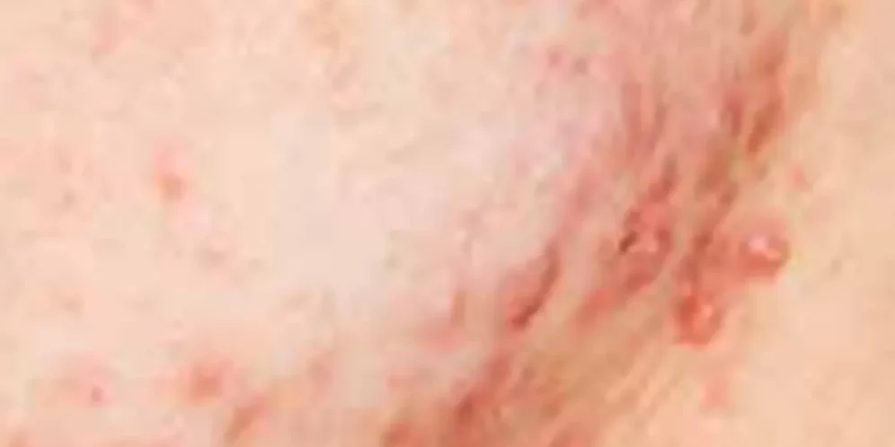 ACNE Curing ACNE With Ozone Therapy