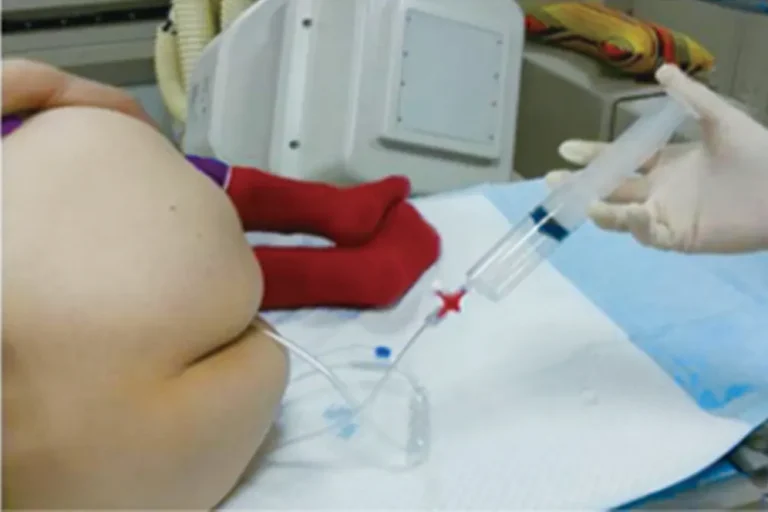 Ozone Rectal Insufflations Ozone Rectal Insufflations