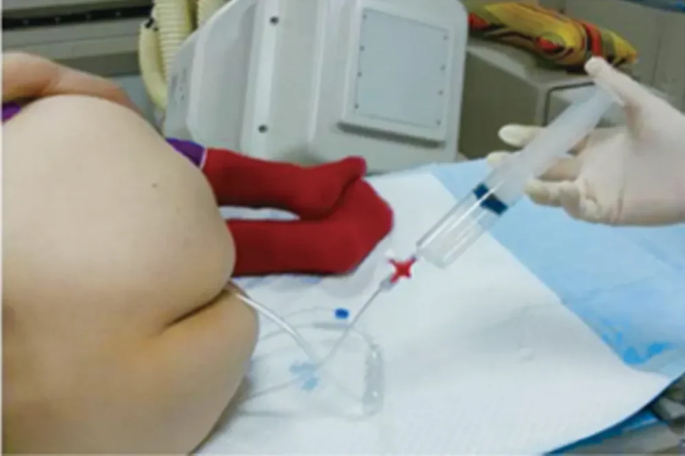 Ozone Rectal Insufflations Ozone Rectal Insufflations